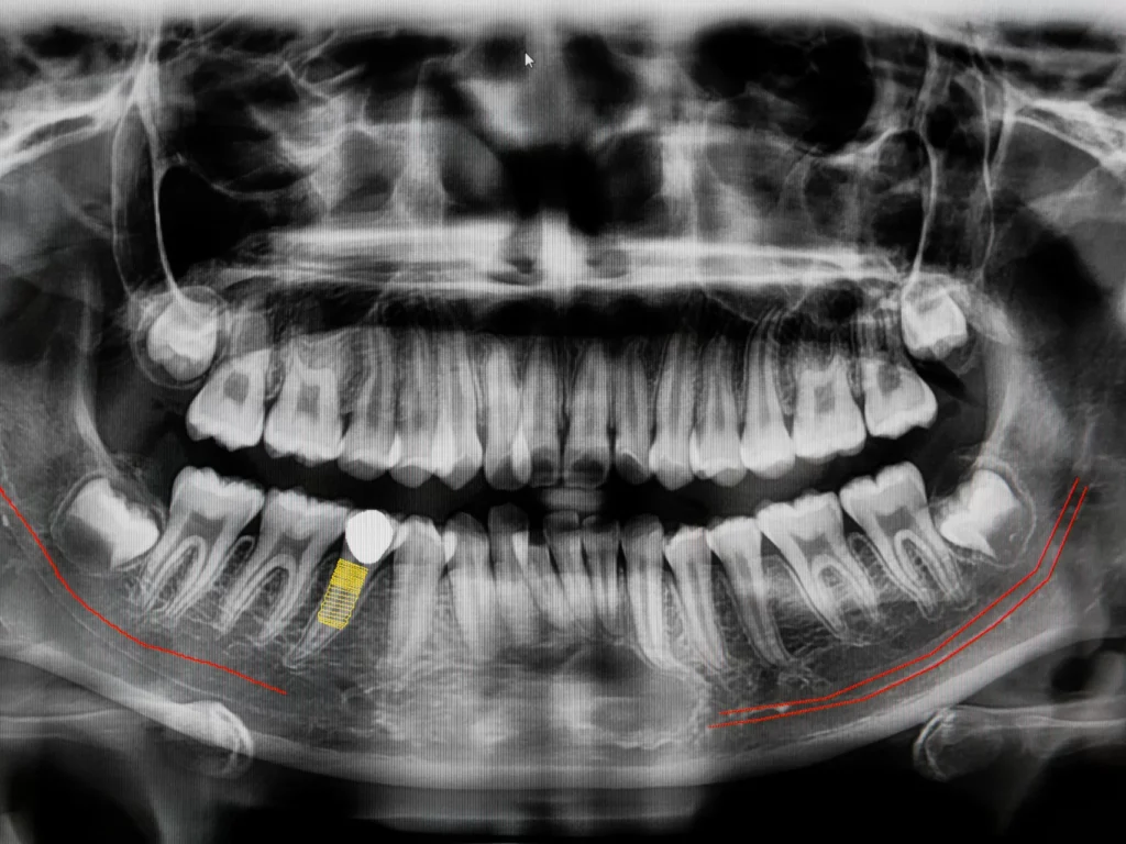 Digital x-ray technology at Nashville Wisdom Teeth & Implant Solutions