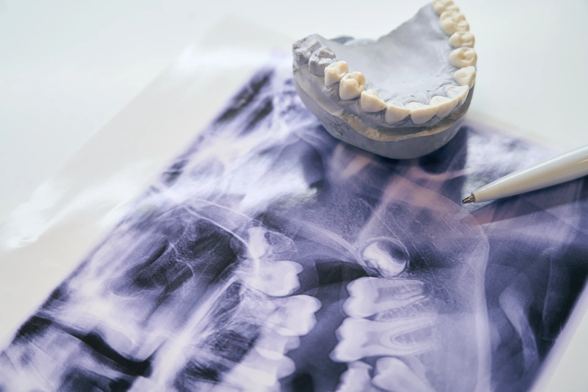 wisdom teeth removal x-ray and tooth model sitting on table