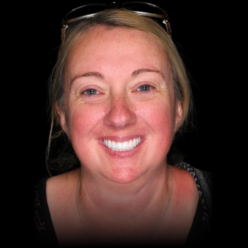 Patient after all on 4 dental implants at Nashville Wisdom Teeth & Implant Solutions