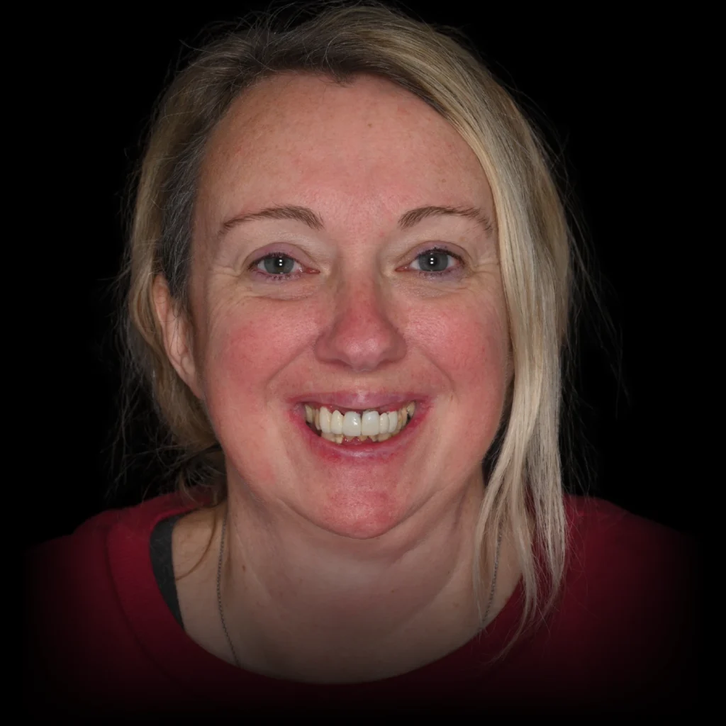 Patient before all on 4 dental implants at Nashville Wisdom Teeth & Implant Solutions